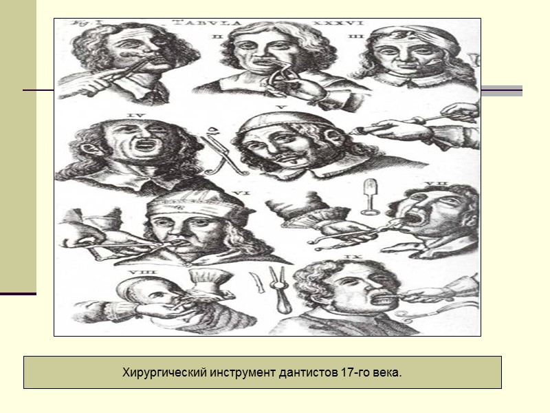 Хирургический инструмент дантистов 17-го века.